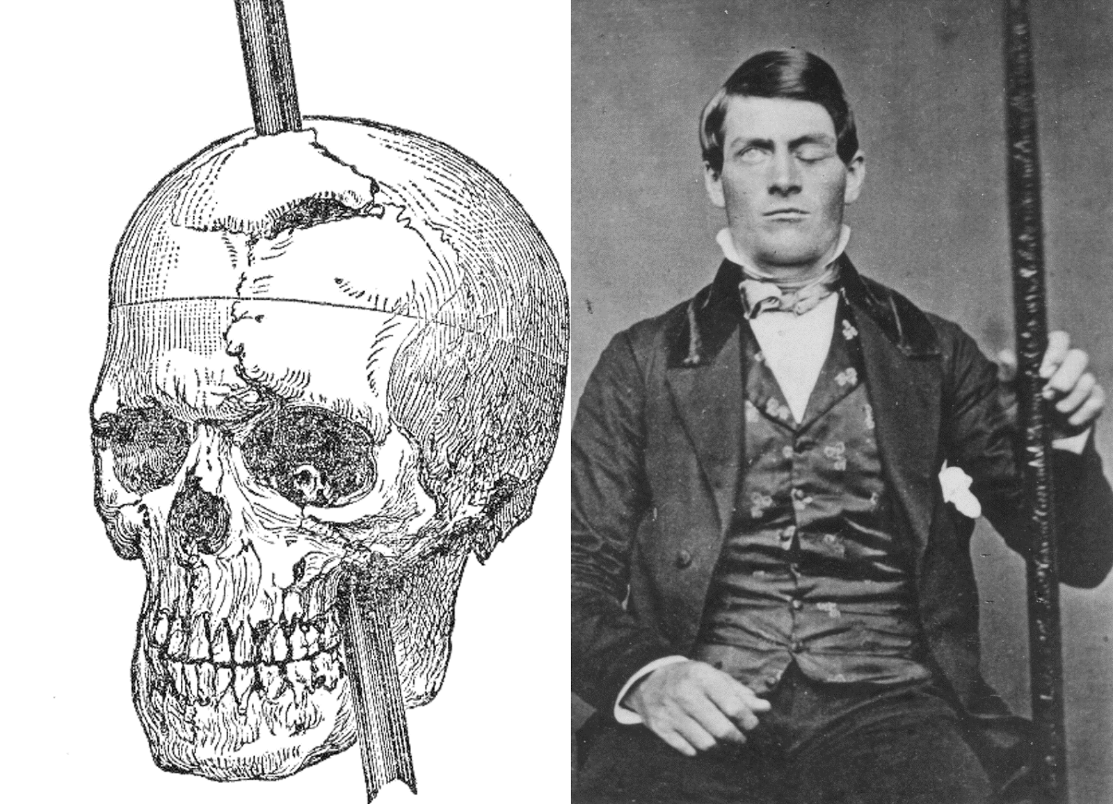 The Curious Case Of Phineas Gage Doctors Impossible The Curious Case Of Phineas Gage Doctors Impossible